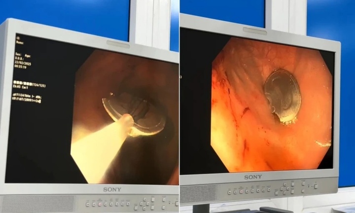 Uống nước ngọt, bé trai sơ ý nuốt nắp lon vào dạ dày