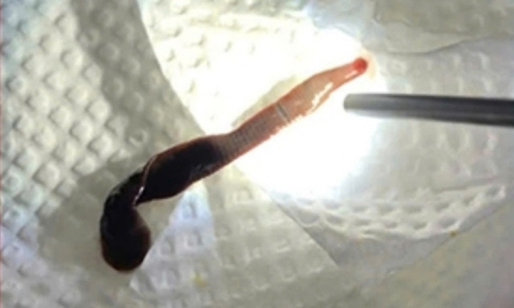 Hy hữu, con vắt dài 8cm sống nhiều ngày trong mũi người phụ nữ ở Đồng Nai