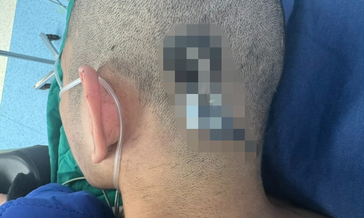 Hy hữu một nam sinh bị chấn thương sọ não do chìa khóa cắm vào đầu