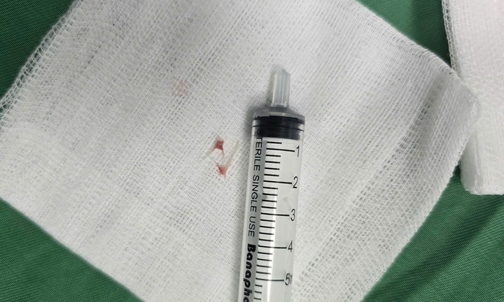 Nguy kịch vì hóc xương cá, bé 16 tháng tuổi nhập viện khẩn cấp