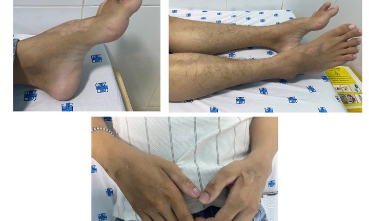 Tê yếu tay chân kéo dài, đi khám phát hiệm mắc căn bệnh hiếm gặp