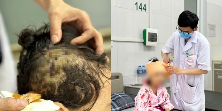 Hà Nội: Hai trường hợp bị tấn công bởi chó nhà nuôi