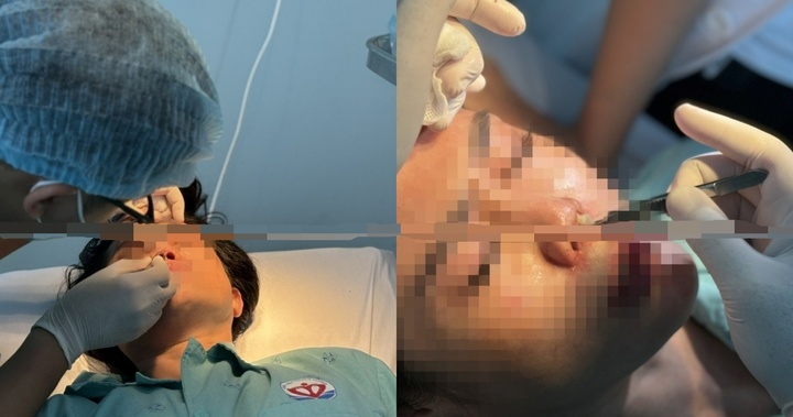 Bi hài hậu vận sau thẩm mỹ: 