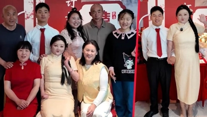 Cô gái bỏng 95% tìm thấy tình yêu bên người chồng sinh cùng ngày, tháng, năm