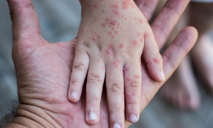 Hà Nội: Phát hiện một ca mắc Rubella ở quận Tây Hồ, chưa được tiêm vắc xin
