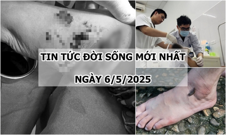Tin tức đời sống 6/5: Cụ bà bị đàn chó cắn, gây nhiều vết thương nghiêm trọng
