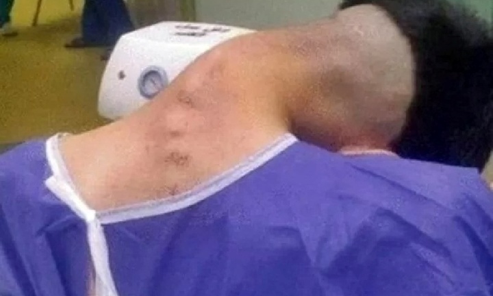 Lạm dụng chất gây nghiện trong thời gian dài, thanh niên 23 tuổi mắc hội chứng 