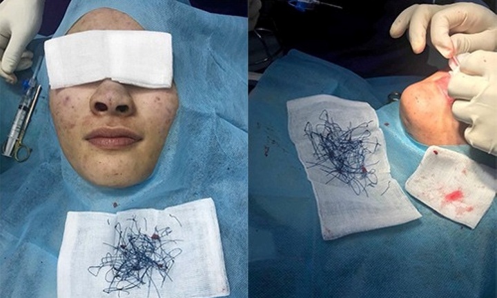 Bi hài hậu vận sau thẩm mỹ: Mũi 