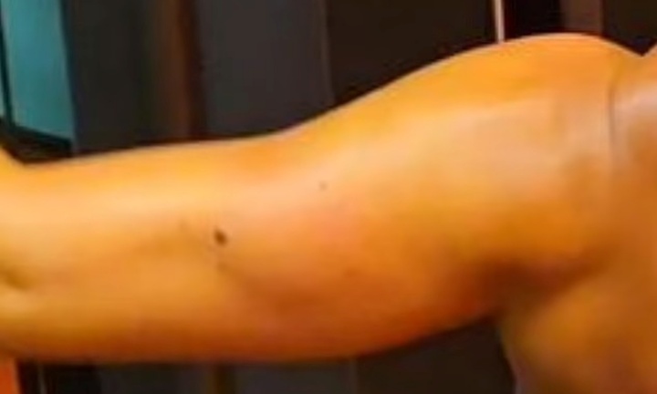 Bỏ qua dấu hiệu bất thường trên cánh tay, người phụ nữ  suýt mất mạng vì ung thư da