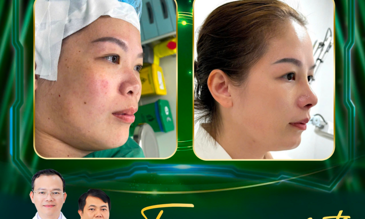 Thẩm Mỹ C.C tái tạo dáng mũi hài hòa – Tăng vẻ đẹp, nâng tầm diện mạo