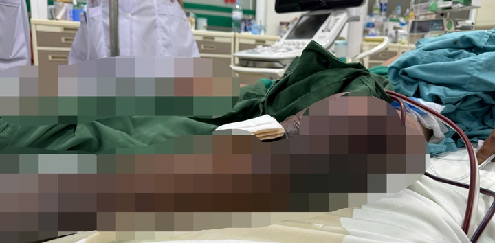 Bị gai đâm khi lội đầm tôm, chân người đàn ông Thanh Hóa hoại tử tím đen