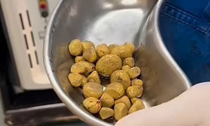 35 viên sỏi 
