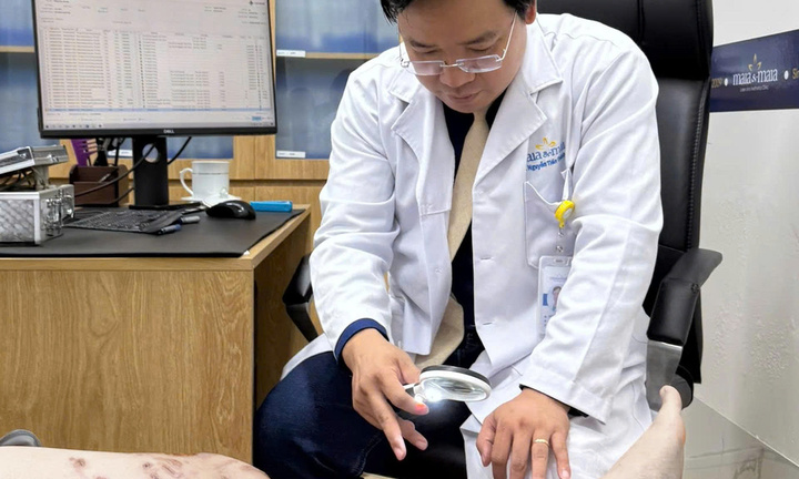 Người đàn ông bỏng da, sẹo phì đại sau 15 phút tắm biển