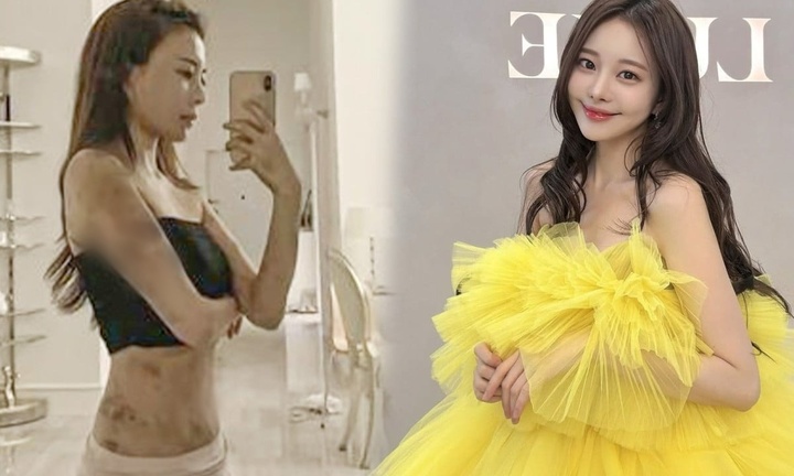 Cựu người mẫu cả người đầy vết bầm tím, đau ngực dữ dội sau khi làm thủ thuật ở phòng khám
