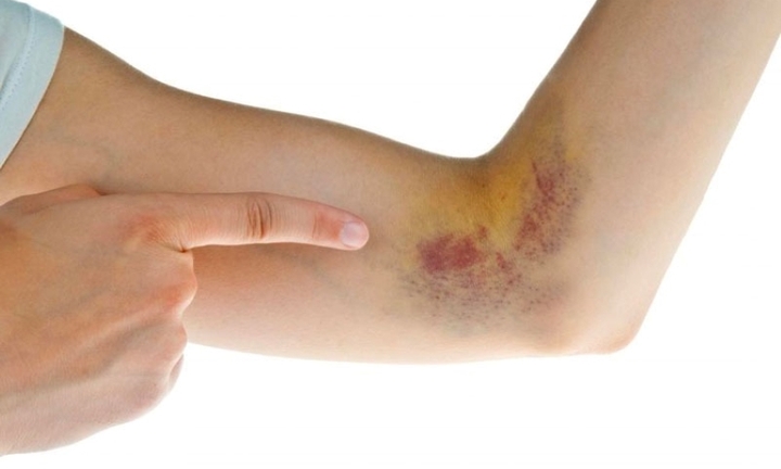 Các nguyên nhân dễ dẫn đến bầm tím trên da