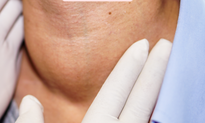 Có nên phẫu thuật bướu cổ lành tính không? Khi nào phải mổ?