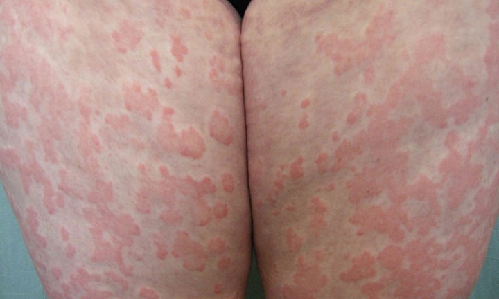 Dị ứng da, mề đay bùng phát vì môi trường ô nhiễm – Giải pháp kiểm soát an toàn từ thảo dược