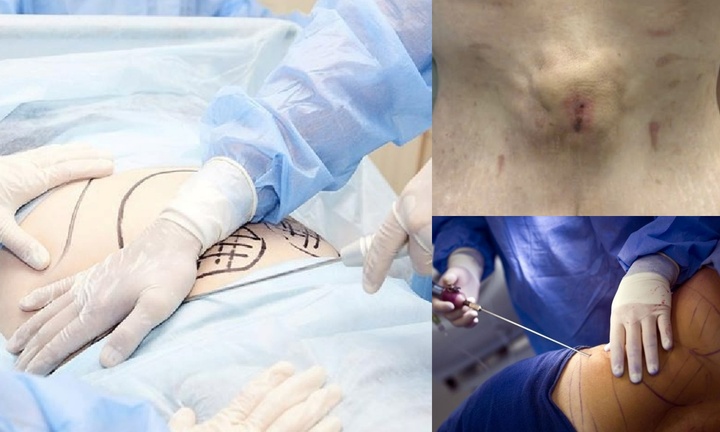 Bi hài hậu vận sau thẩm mỹ: Cấp cứu vì hoại tử bụng sau khi căng da, hút mỡ theo quảng cáo Facebook