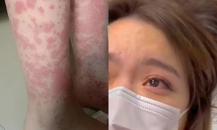 Cô gái trẻ suy thận, cạo đầu sau hai năm nhuộm tóc liên tục