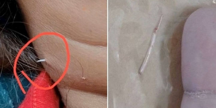 Đau cổ dữ dội, người phụ nữ bàng hoàng phát hiện vật lạ nhô ra từ cổ mình