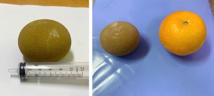 Phẫu thuật loại bỏ sỏi 