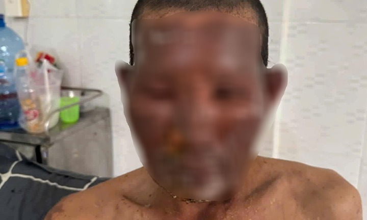 Bình gas  mini phát nổ, 8 người đang ăn giỗ phải nhập viện