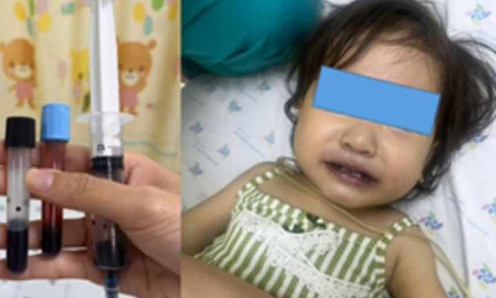 Bé gái 16 tháng tuổi tím tái, máu chuyển màu nâu sẫm sau khi ăn canh nấu bằng nước giếng
