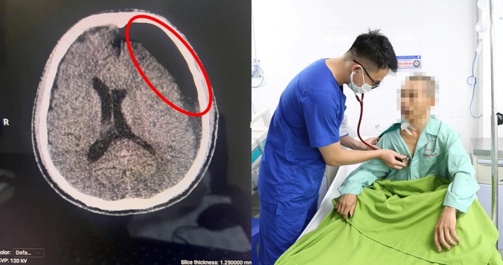 Người đàn ông bất ngờ hôn mê sau 2 tháng ngã xe đạp điện, va đầu vào trụ cổng