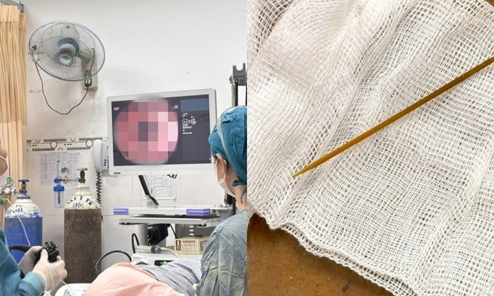 Nam thanh niên bị thủng manh tràng do nuốt phải thứ không ngờ