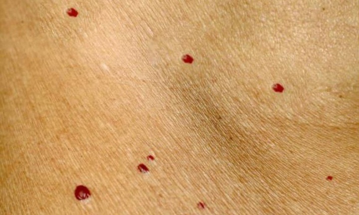 Nốt ruồi son là bệnh gì?