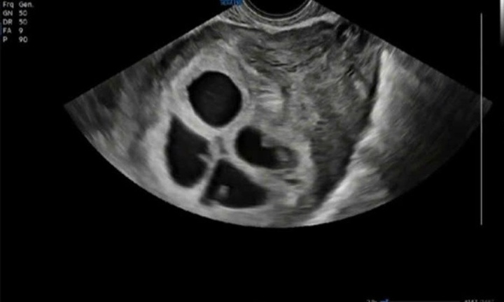 Người phụ nữ đang mang 4 thai cùng lúc, tỷ lệ chỉ 1/800.000