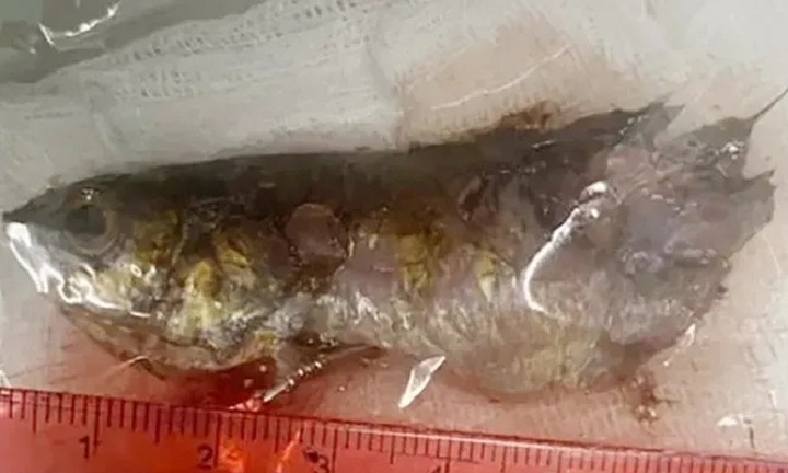 Con cá rô bất ngờ chui tọt vào cổ họng bé trai 4 tuổi