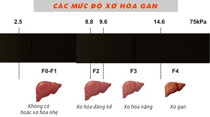 Từ xơ gan F4 đến hồi phục kỳ diệu nhờ Y học tái tạo: Hành trình sống lại của người phụ nữ 66 tuổi