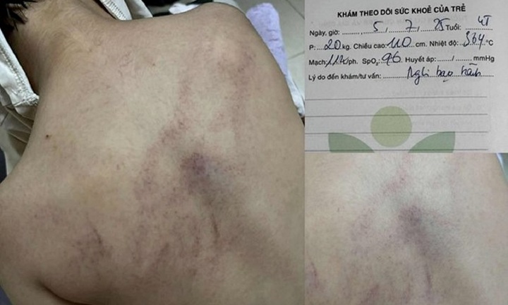 Vụ bé gái 4 tuổi bị đánh, kéo lê ở trường mầm non: Công an vào cuộc, tiết lộ về nữ giáo viên thứ 2 bị đình chỉ