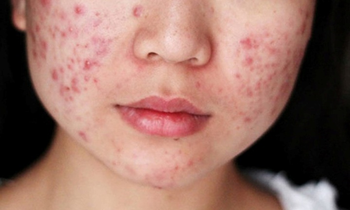 Dấu hiệu cảnh báo gan nhiễm mỡ  trên khuôn mặt