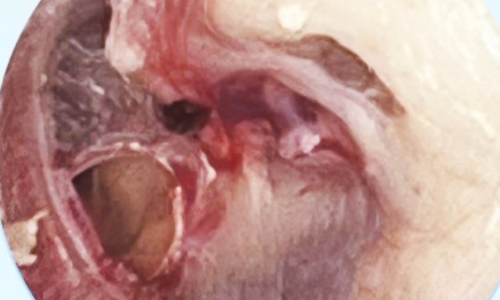 Con trai chơi bóng trong nhà, vô tình khiến mẹ nhập viện cấp cứu vì thủng màng nhĩ