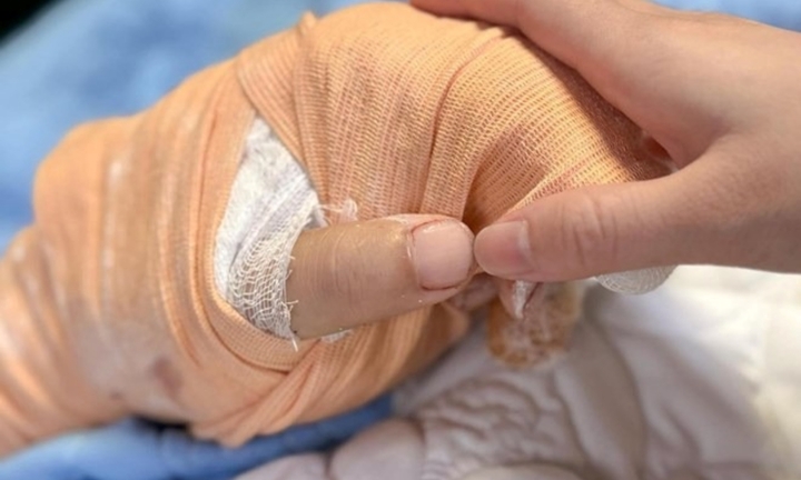 Nối thành công bàn tay bị chém gần đứt cho nam TikToker ở Thái Nguyên