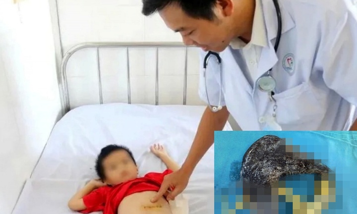 Bé trai 5 tuổi nuốt gần 0,5kg  tóc vì mắc bệnh hiếm gặp