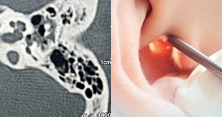  Trẻ nhỏ vô tình va trúng, người phụ nữ thủng màng nhĩ khi ngoáy tai