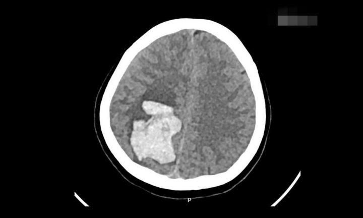 Đột quỵ ở tuần thai 19, bác sĩ kích hoạt “Code Stroke” cứu nguy hai mẹ con