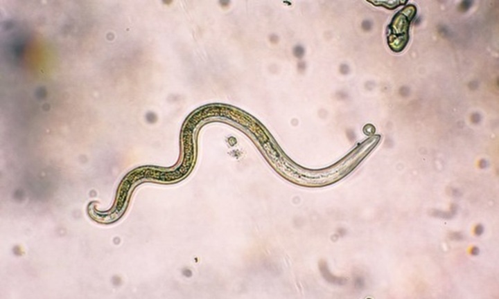 Kinh hãi phát hiện giun đũa chó mèo 4cm chết trong mắt cụ bà 67 tuổi