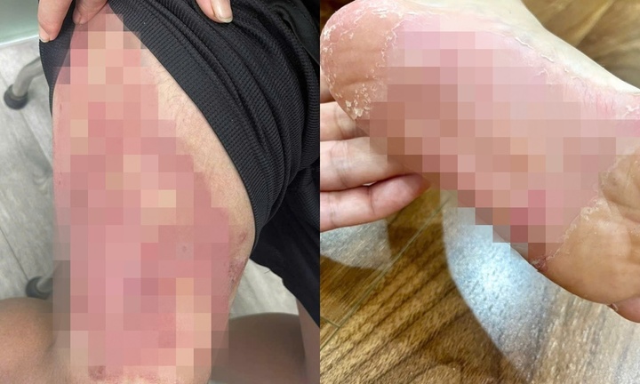 Một vết ngứa nhỏ có thể thành ổ nhiễm trùng, bác sĩ cảnh báo loại bệnh sau mưa lũ