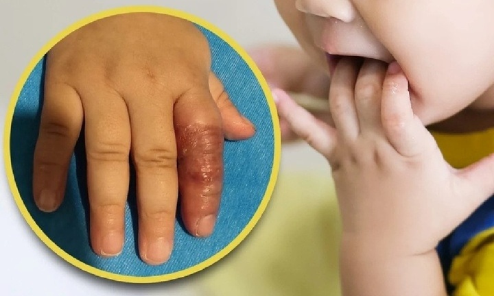 Làm theo mẹo trên mạng nhằm ngăn con 11 tháng mút tay, người mẹ suýt gây họa