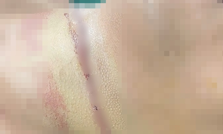 Thanh Hóa: Bị dây thép vắt ngang đường cứa vào cổ khi đang đi xe máy, người đàn ông suýt mất mạng