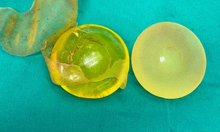 Kiểm tra sức khỏe định kỳ, bất ngờ phát hiện túi silicon nâng ngực bị vỡ