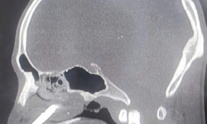 Đang vận hành máy khoan đá, mũi khoan bật ra đâm xuyên hốc mũi nam công nhân