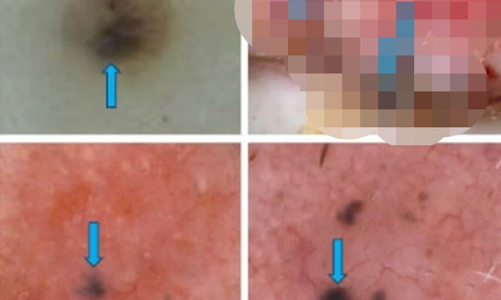 Người đàn ông nhận tin dữ sau vài lần đốt 