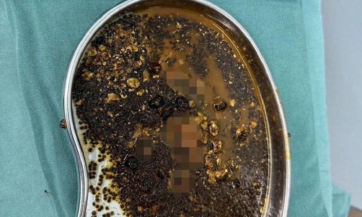 Phát hiện hàng trăm viên sỏi mật trong bụng người phụ nữ, bác sĩ cảnh báo 5 điều quan trọng