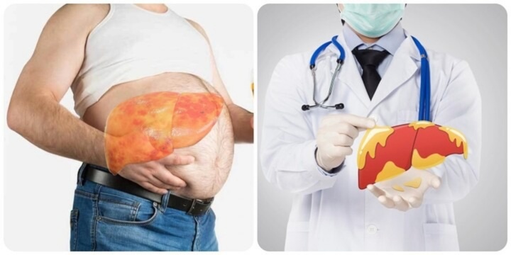 Dấu hiệu cảnh báo gan đang 