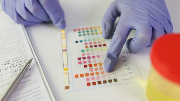 Bị suy thận nước tiểu sẽ có màu gì?